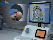 中国首款脑部磁共振监测激光消融治疗系统